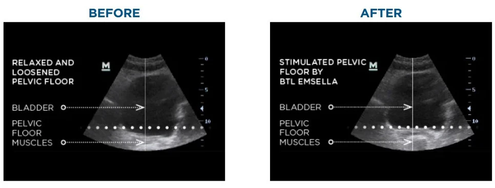 Emsella Elkton MD Pelvic Floor Before and After